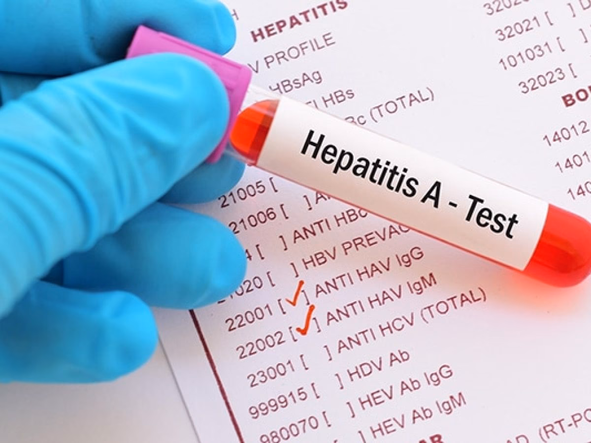 ¿Cuál es el agente causal de la hepatitis viral?
