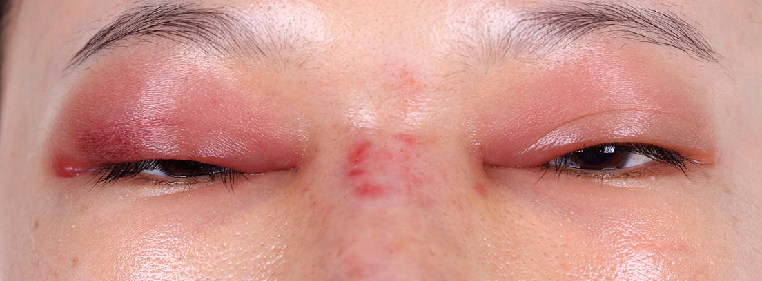 ¿Qué es el angioedema inducido por medicamentos?