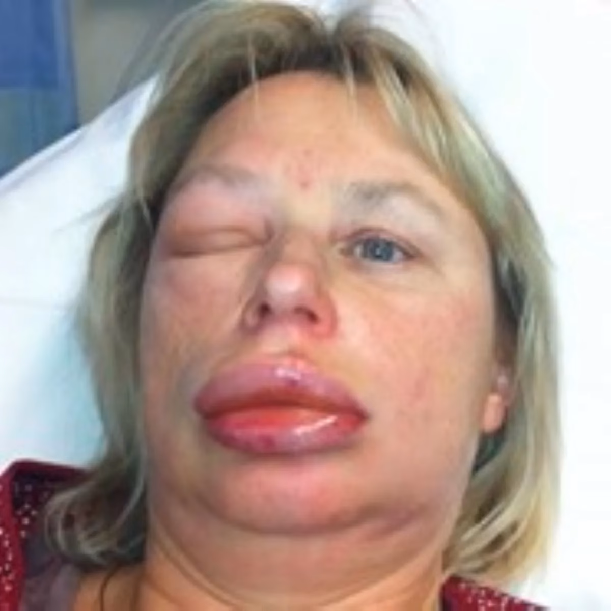 ¿Cómo prevenir el angioedema?