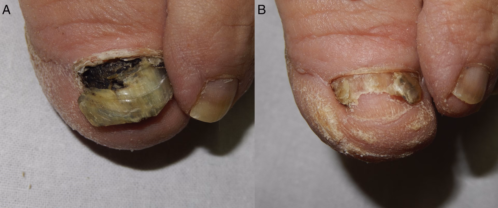 ¿Cómo se diagnostica la infección por Aspergillus?