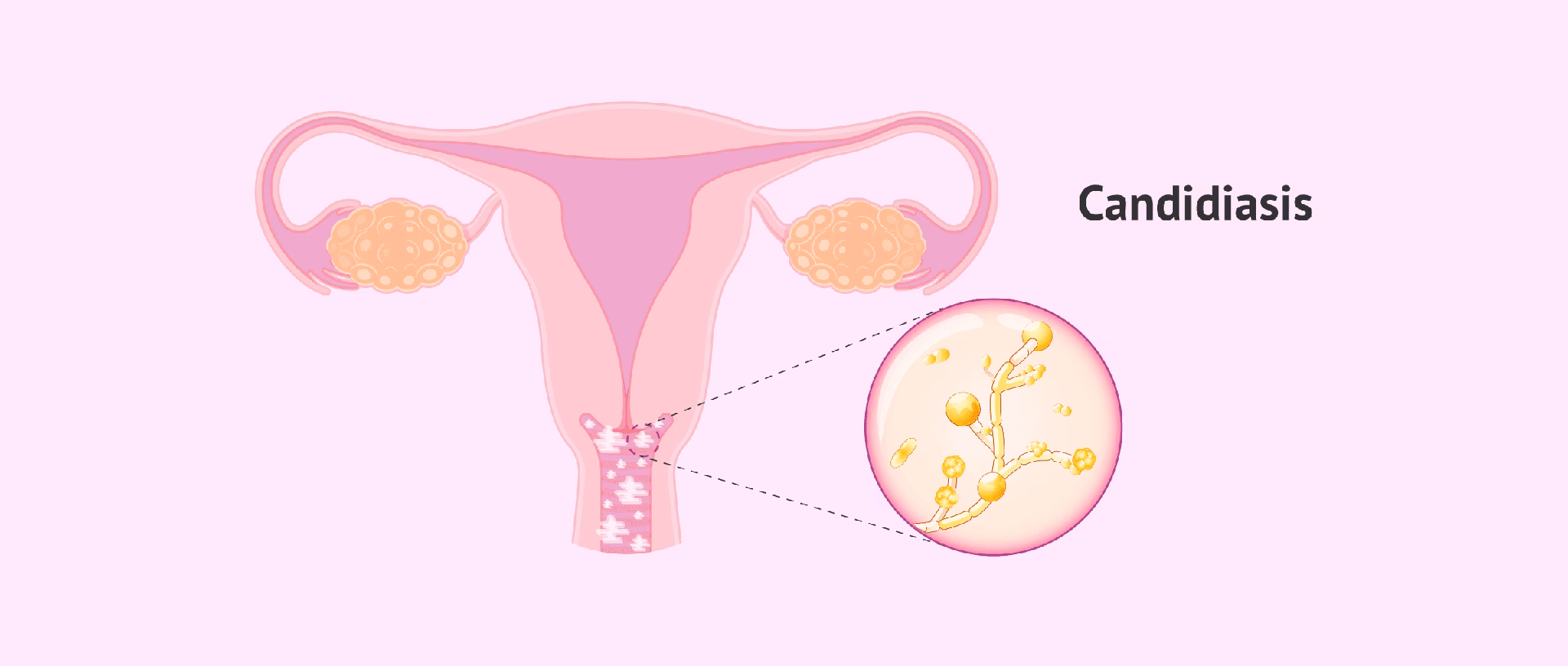 ¿Cómo limpiar la ropa interior con Candida?