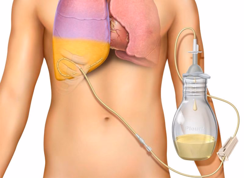 ¿Cómo desinfectar un catéter?