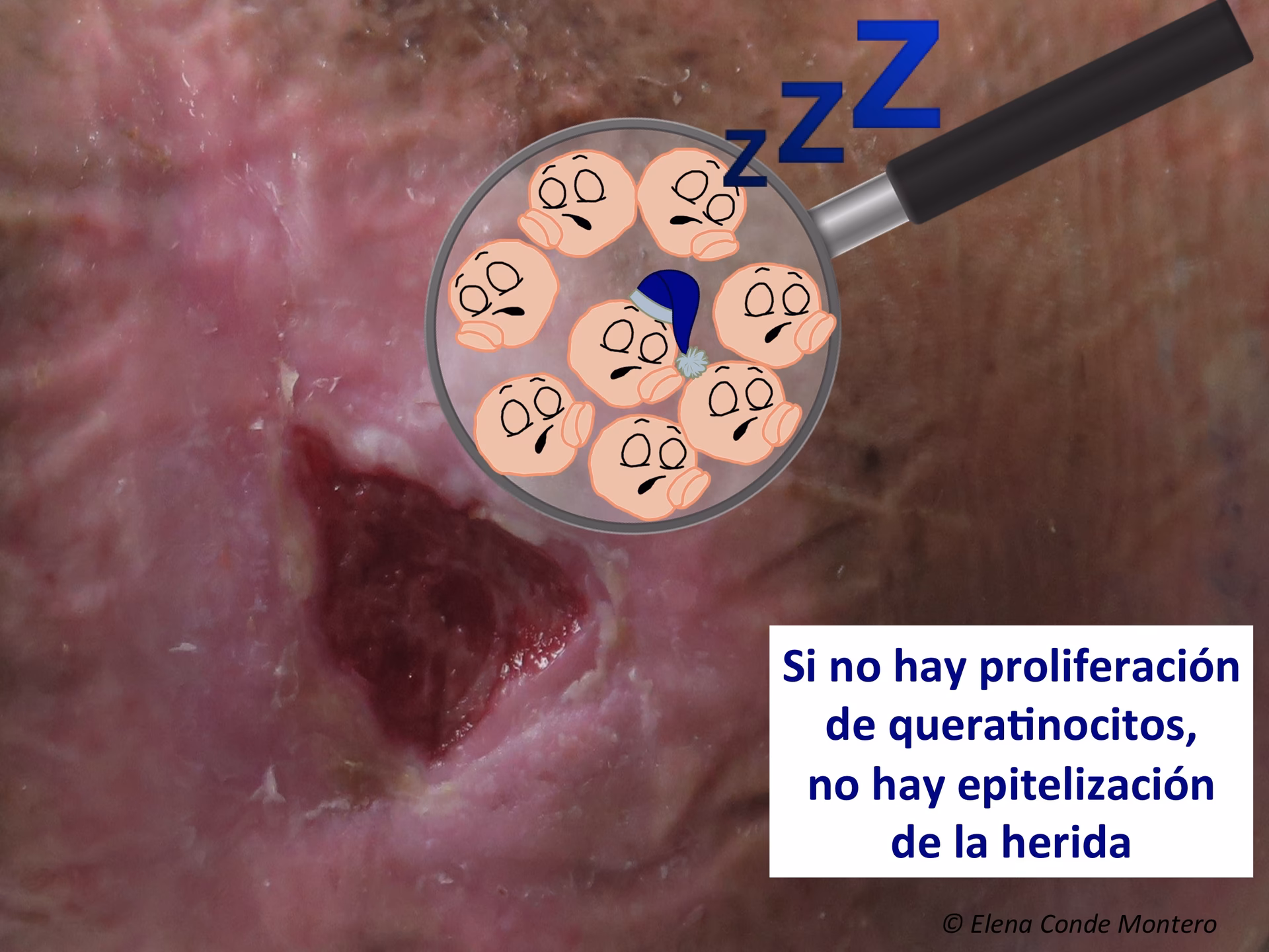 ¿Qué es una herida?