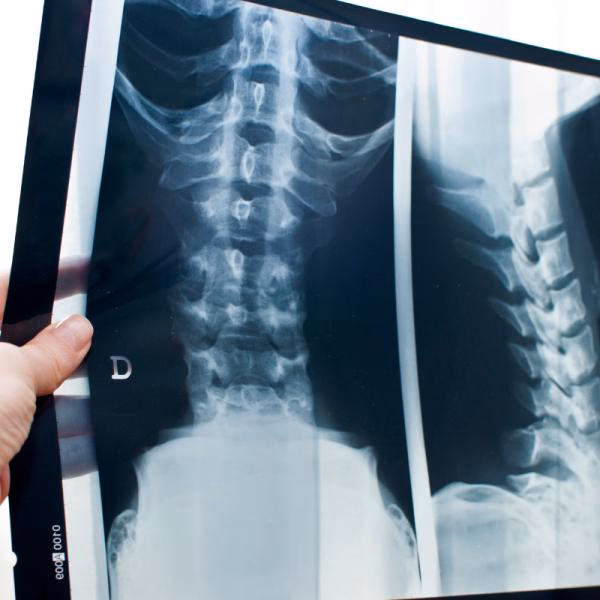 ¿Cuál es el riesgo de cáncer con la radiación?