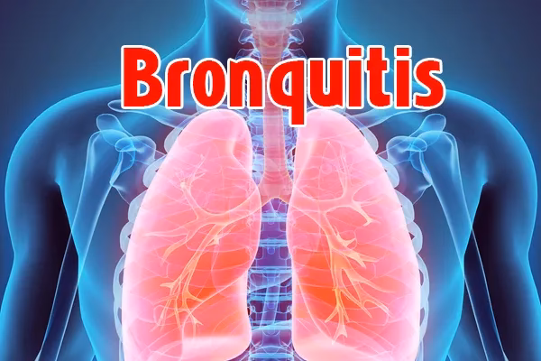 ¿Cómo prevenir la bronquitis bacteriana?