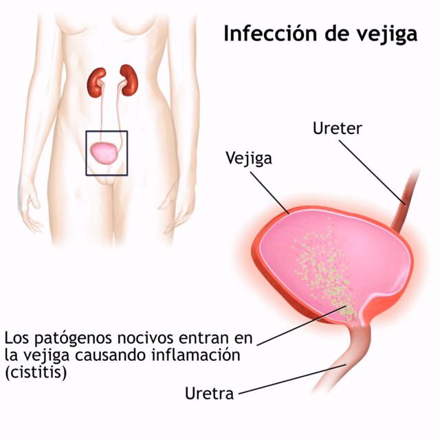 ¿Cuáles son las infecciones urinarias en el adulto mayor?