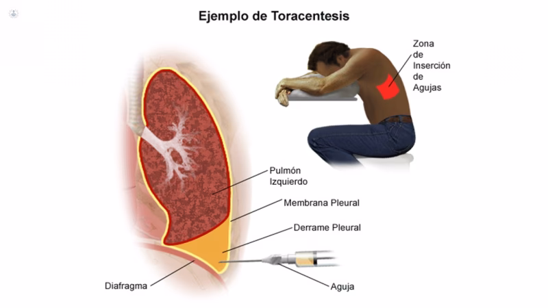 ¿Qué contraindicaciones tiene la toracocentesis?