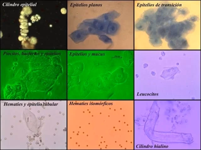 ¿Cómo se colocan las sondas urinarias?