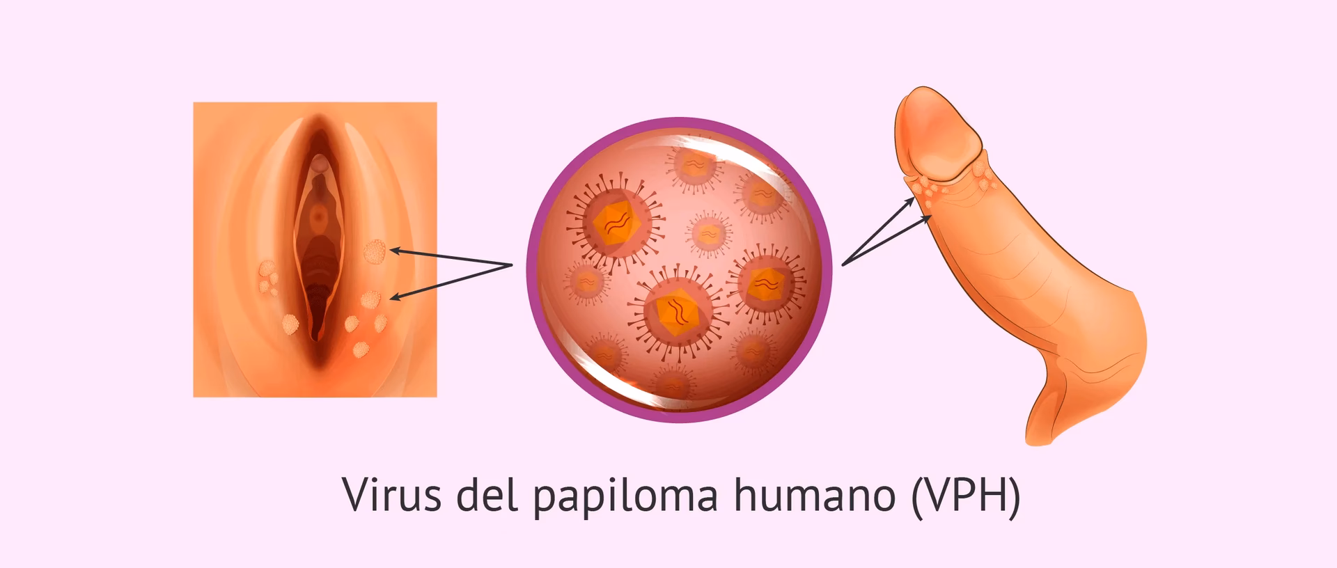 ¿Cómo prevenir el HPV?