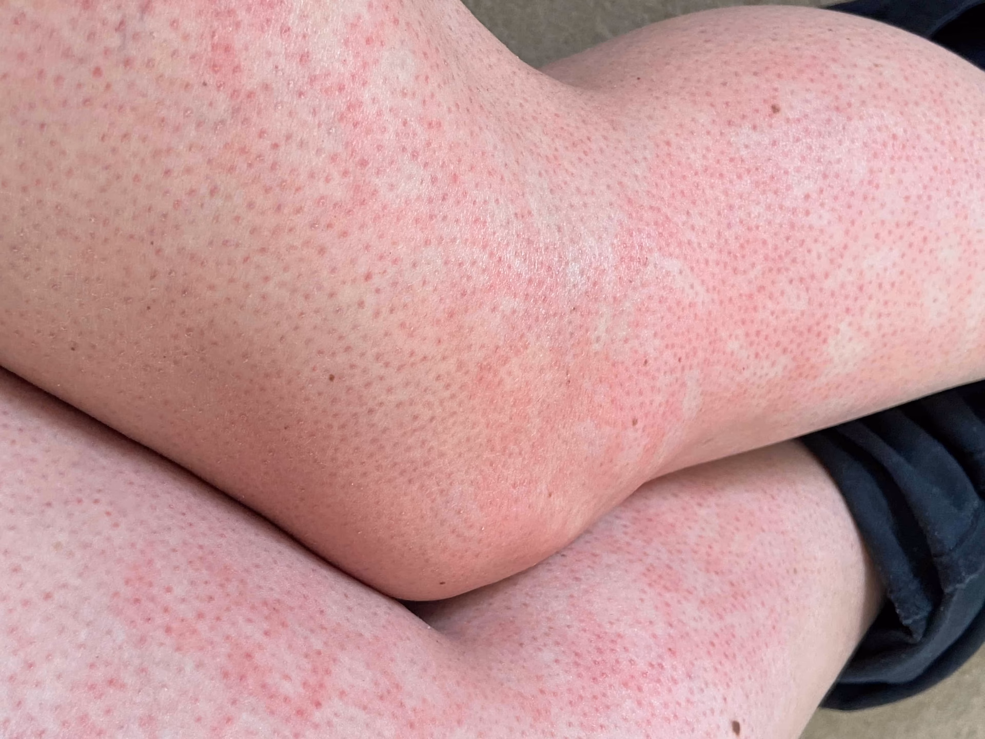 ¿Cómo afectan los corticoides a los niños?