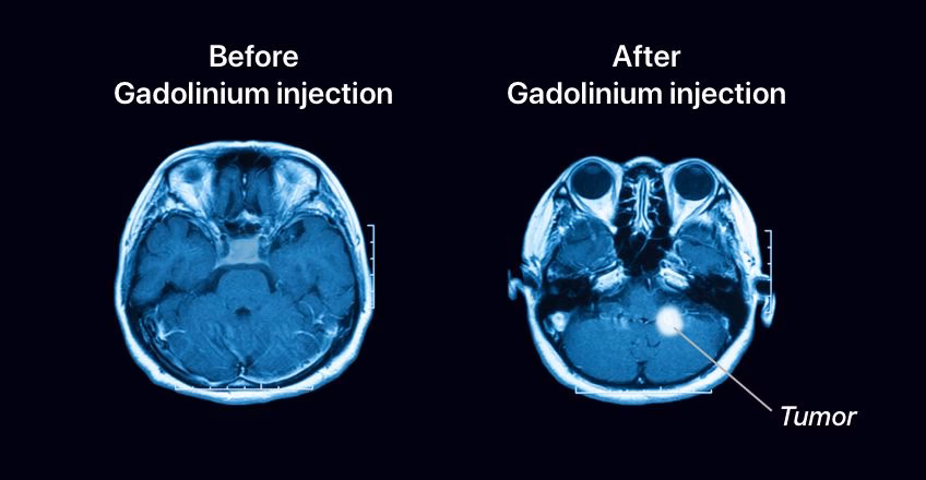 Can gadolinium cause adverse events in Canada?