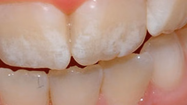 ¿Cuándo no se debe usar agua después de lavar los dientes?