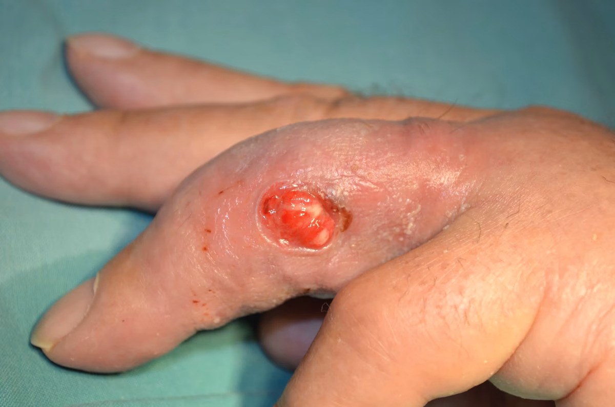 ¿Cómo se clasifican las heridas según el riesgo de infeccion?