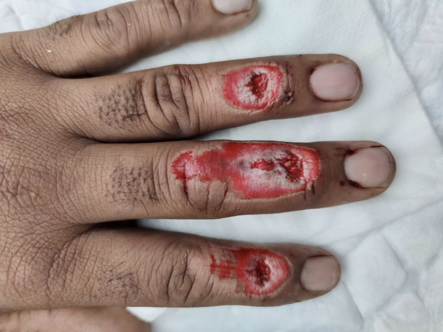 ¿Qué se necesita para simular una herida contaminada?