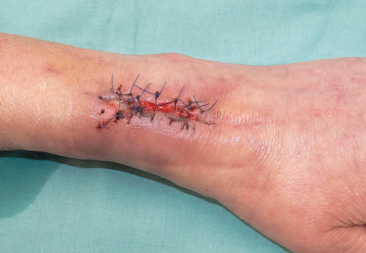 ¿Cómo tratar las heridas?