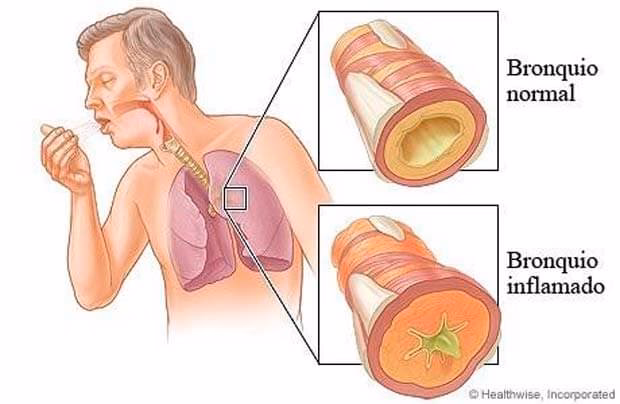 ¿Cuáles son los efectos del broncoespasmo?
