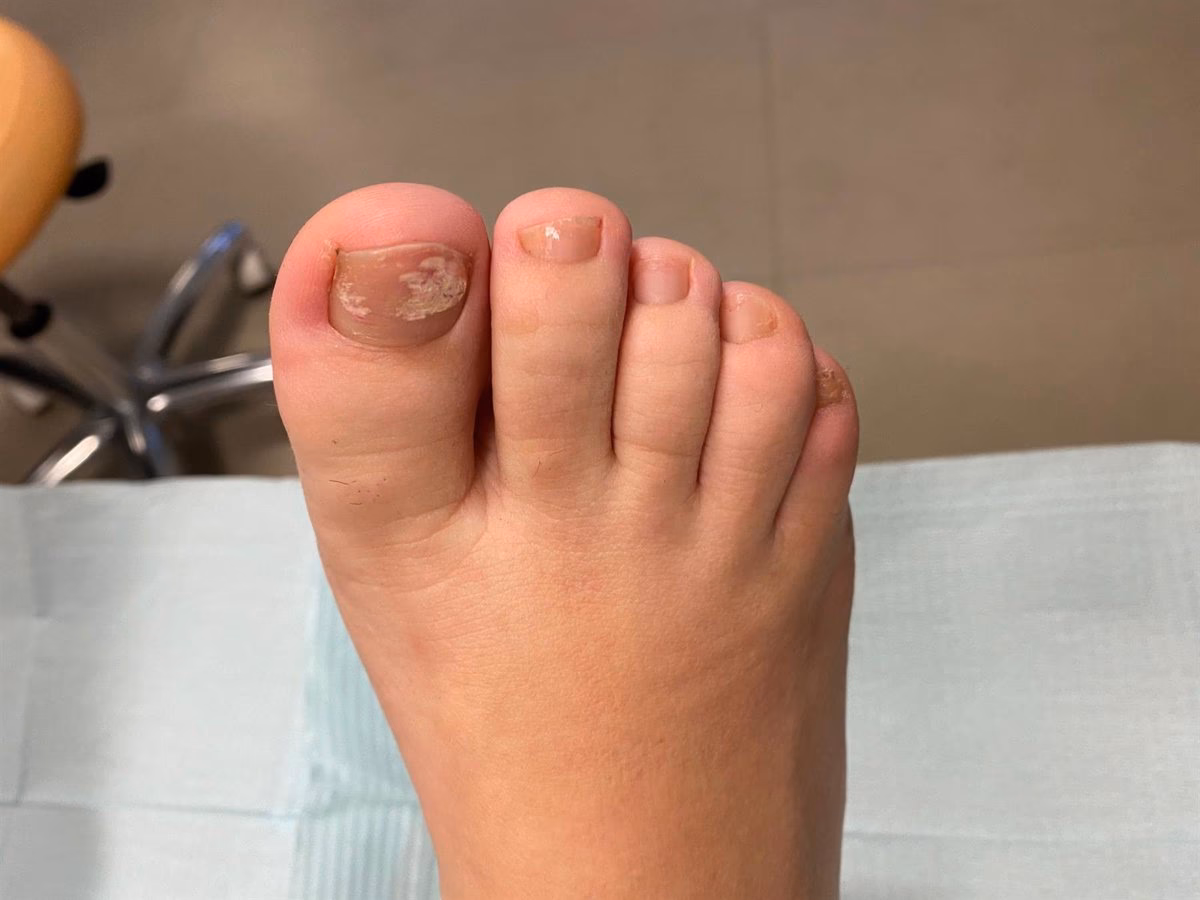 ¿Cuál es el dermatofito más prevalente en uñas contaminadas por hongos?