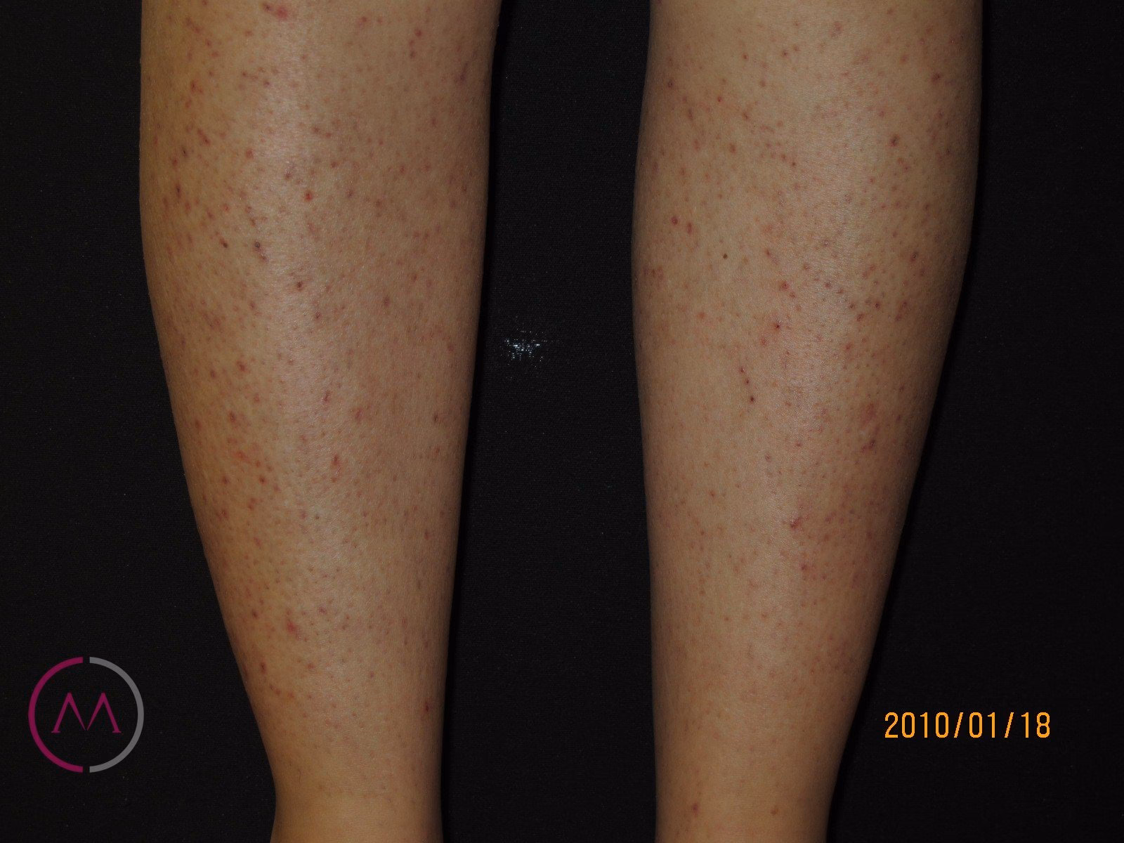 ¿Cómo puedo saber si un brote está contaminado?