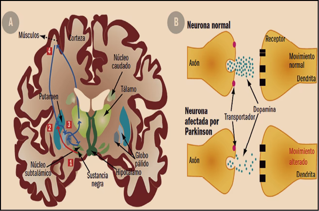 ¿Cuáles son los ismos de neurodegeneración en la enfermedad de Parkinson?
