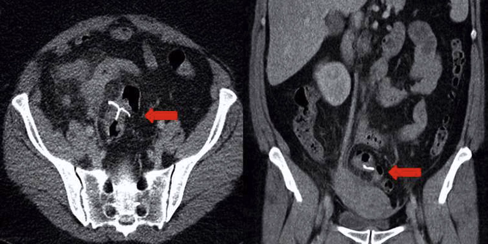 ¿Cómo saber si tengo infeccion por el DIU?