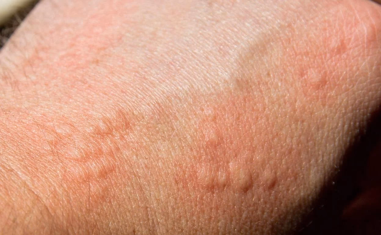 ¿Cuáles son los síntomas de la intoxicación al pescado?