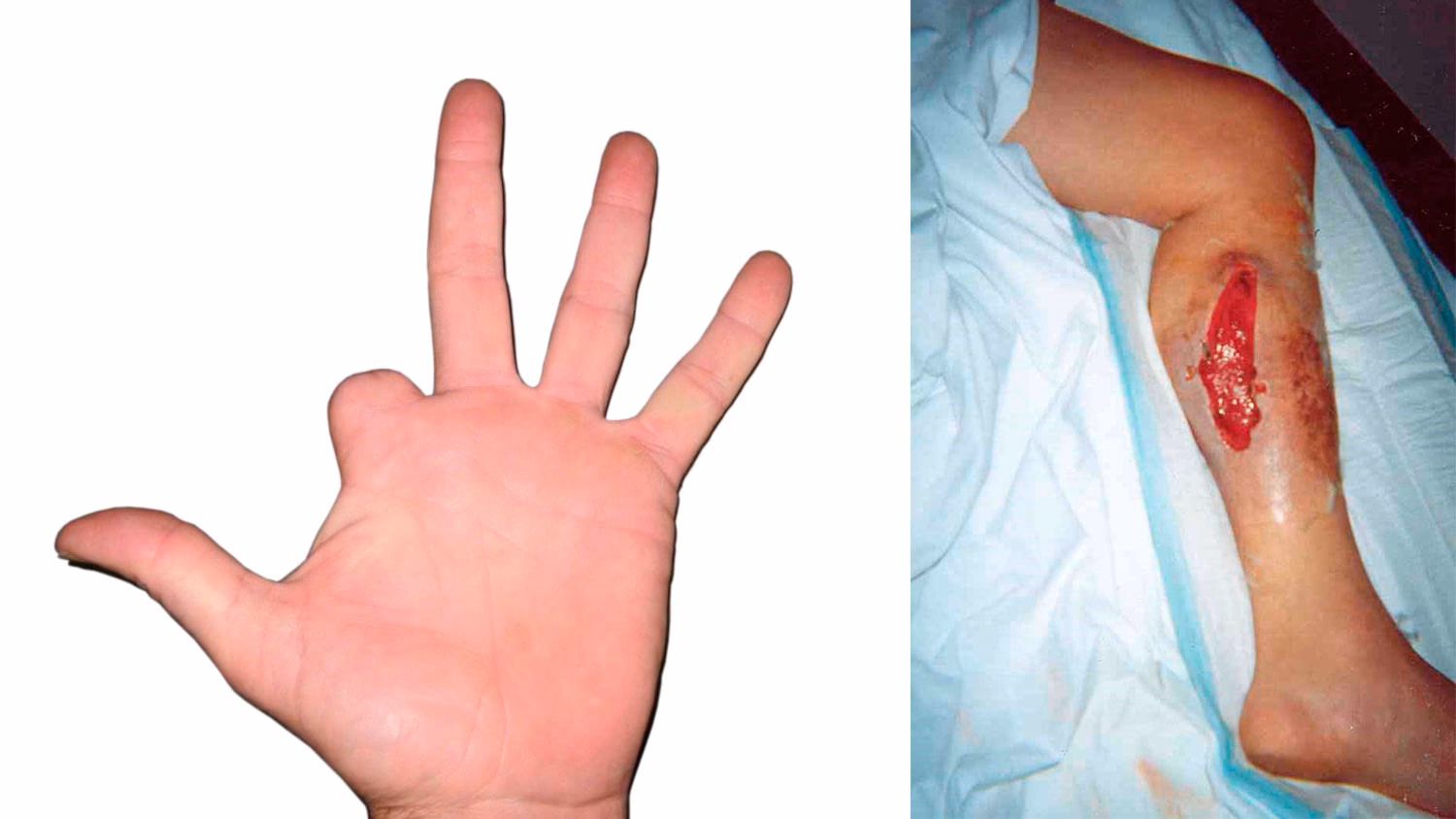 ¿Cuáles son los riesgos de los pinchazos con agujas?