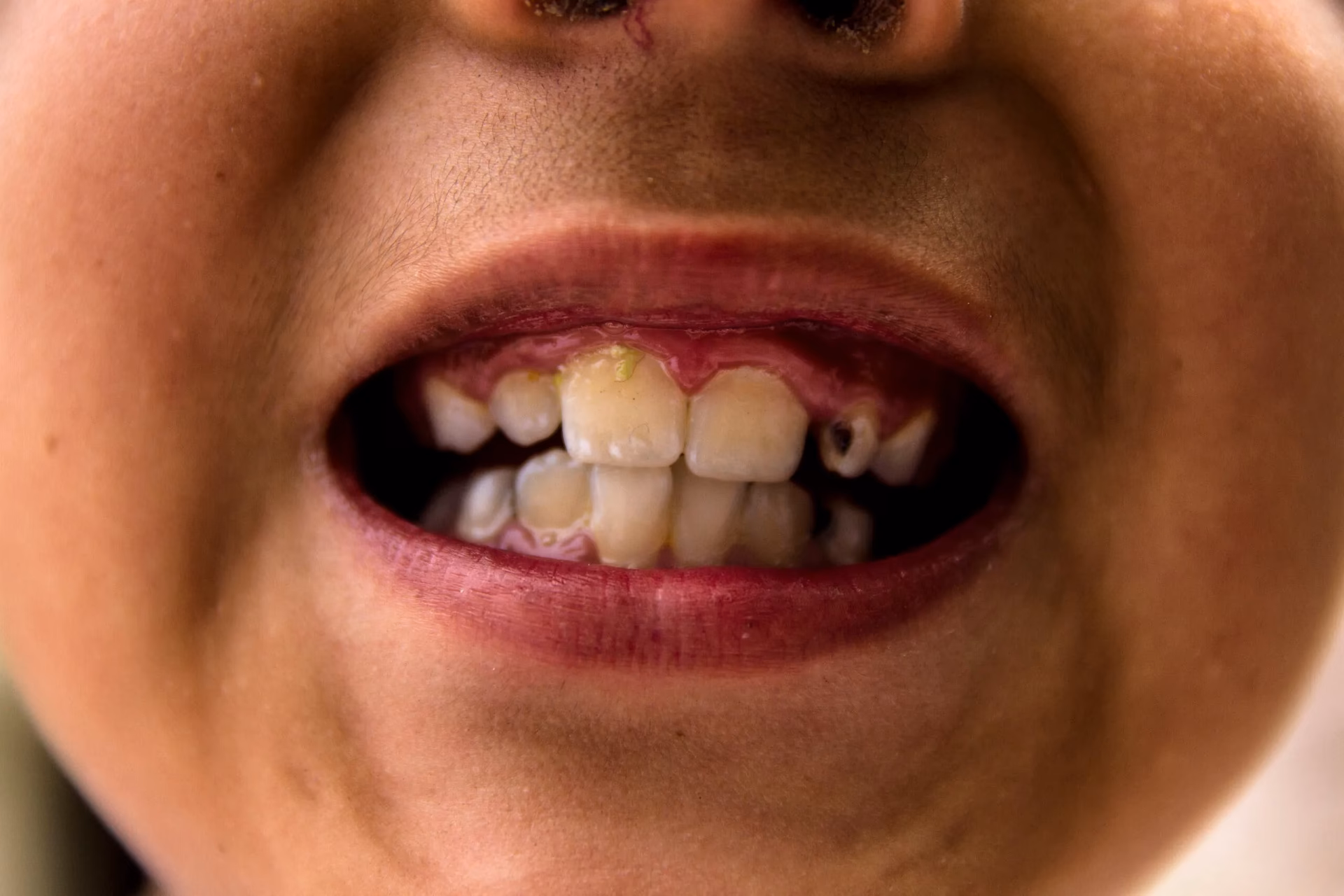 ¿Cómo evitar que los dientes se tiñan con los pigmentos de los alimentos?