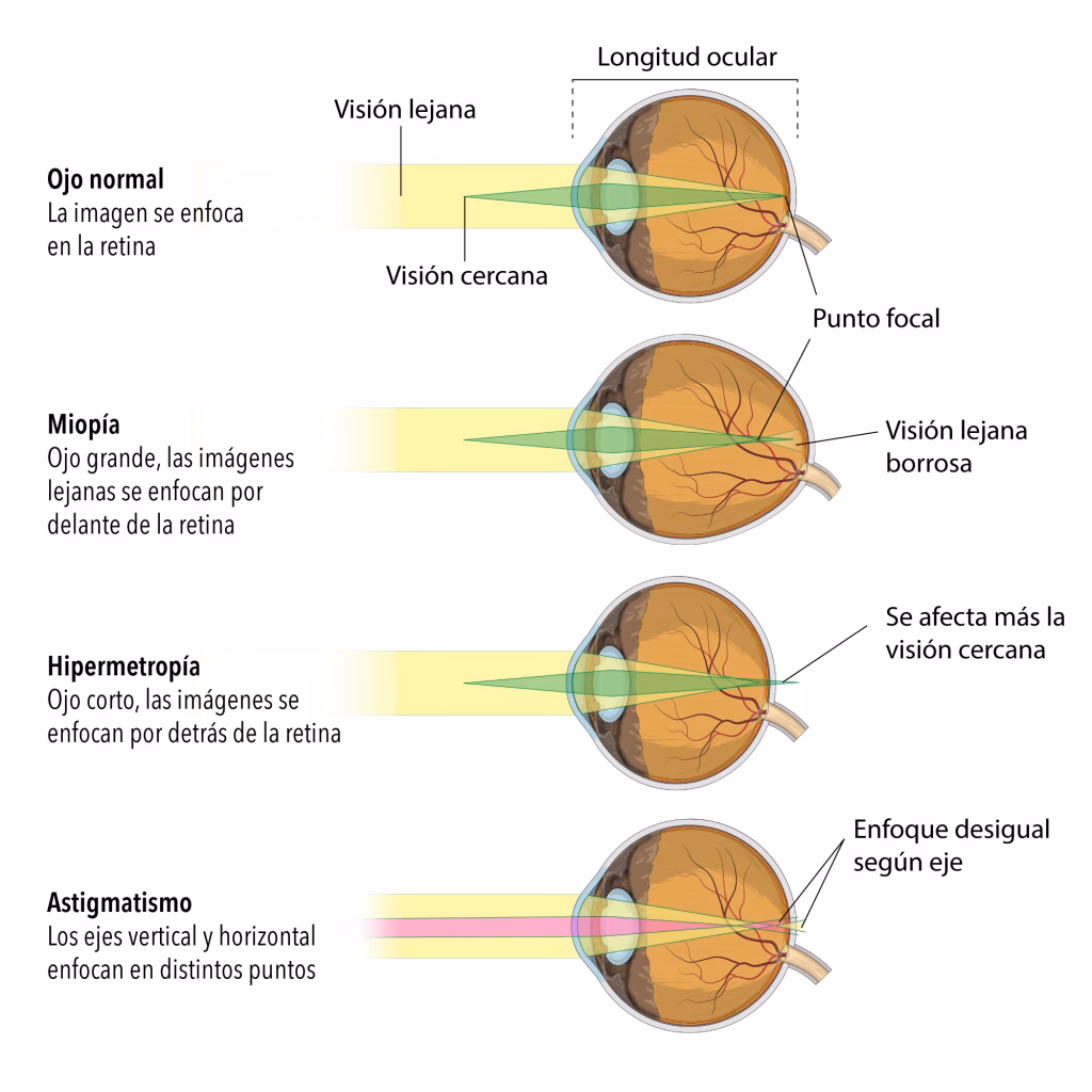 ¿En qué áreas del mundo la miopía es más prevalente?