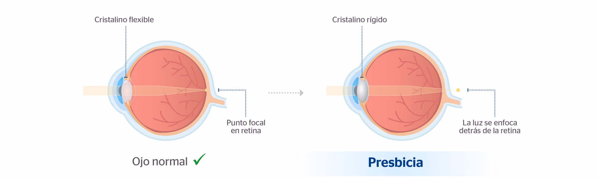 ¿En qué áreas del mundo la miopía es más prevalente?
