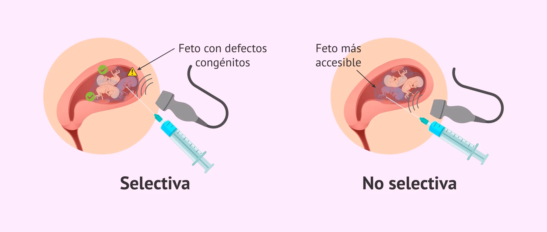 ¿Cómo expulsar el saco gestacional?