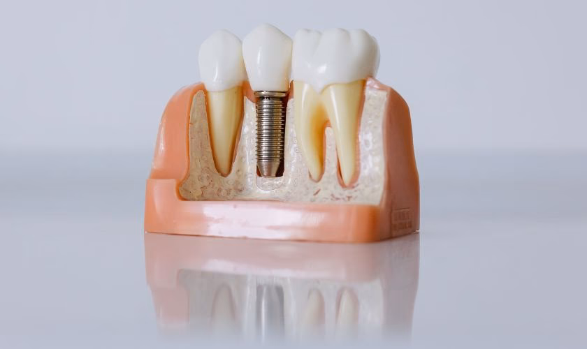 ¿Qué pasa si no se cuidan los implantes dentales como se debe?