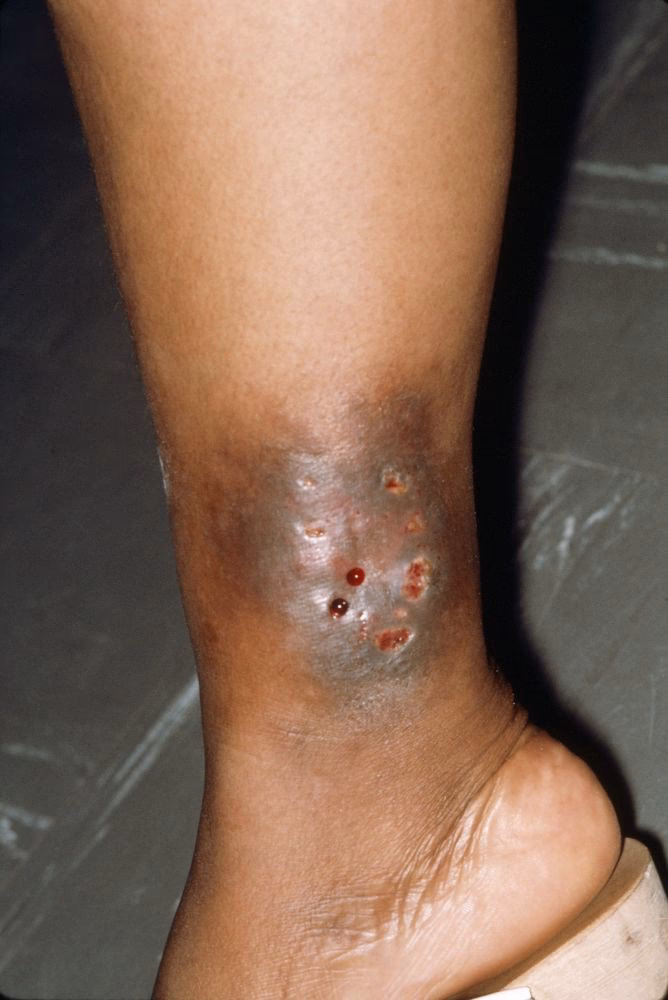 ¿Cuáles son las causas de la sífilis?