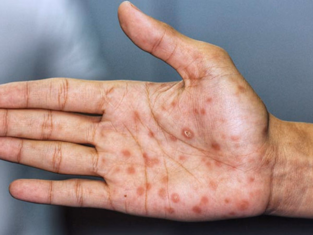 ¿Qué se debe hacer en caso de sífilis congénita?