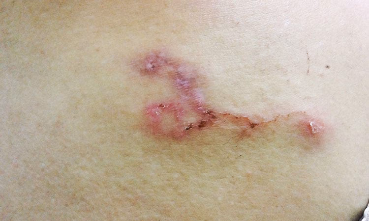 ¿Cómo prevenir las infecciones primarias por Strongyloides?