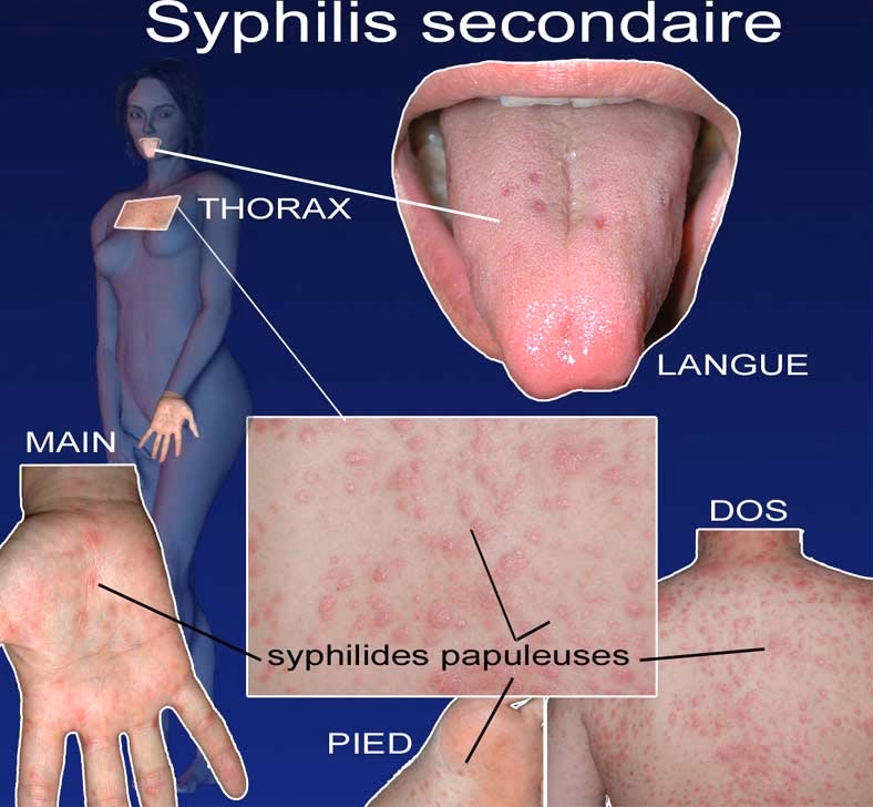 Est-ce que la syphilis est contagieuse ?