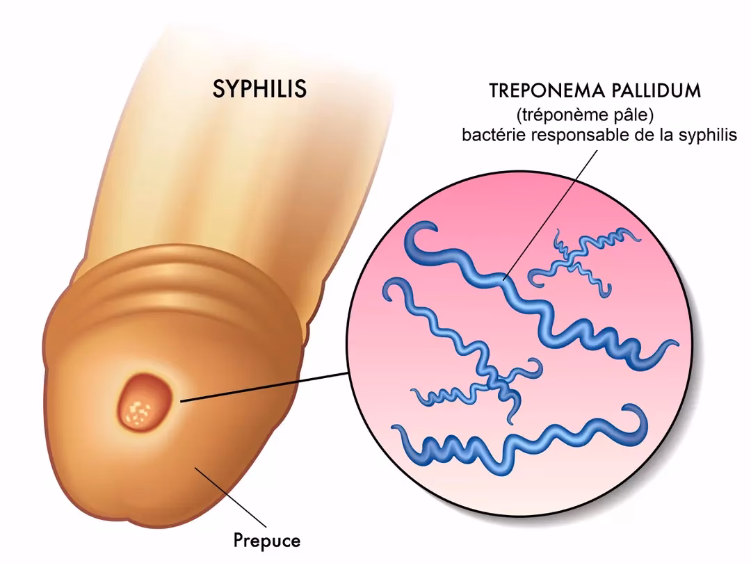 Quelle est la complication la plus fréquente de la syphilis ?