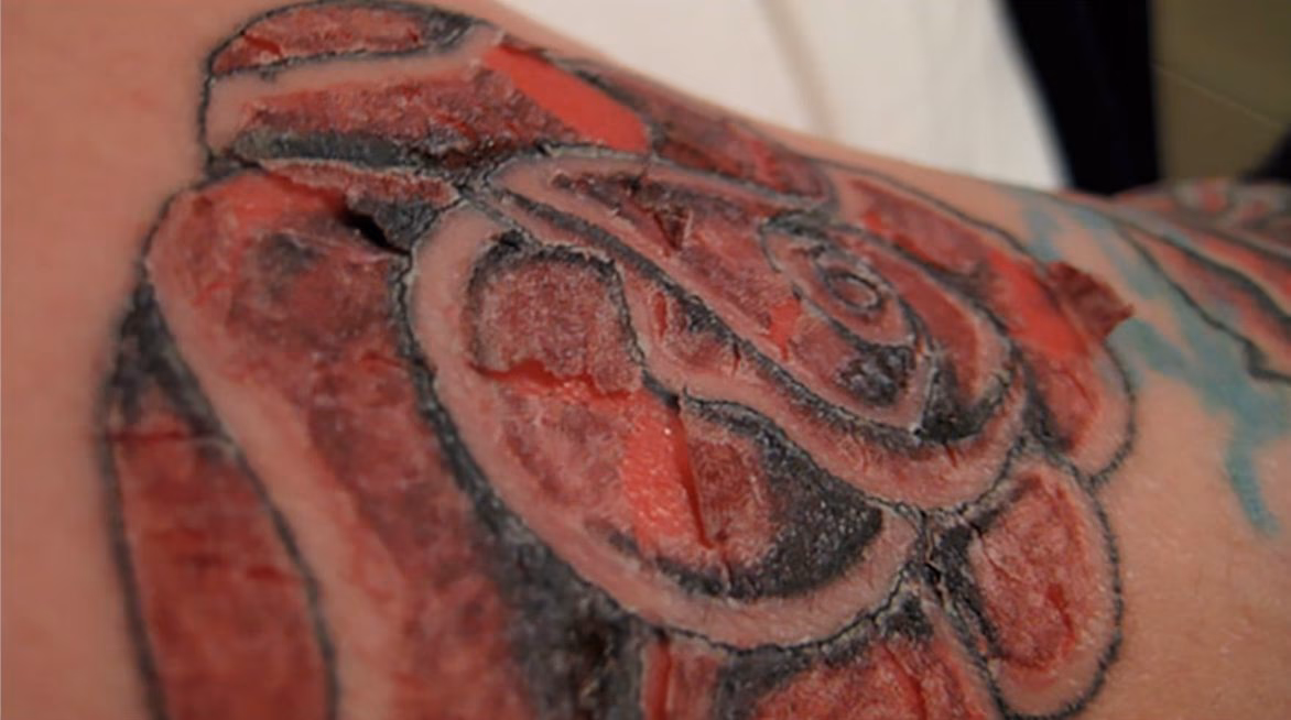 ¿Cómo se toma la sangre de un accidentado?