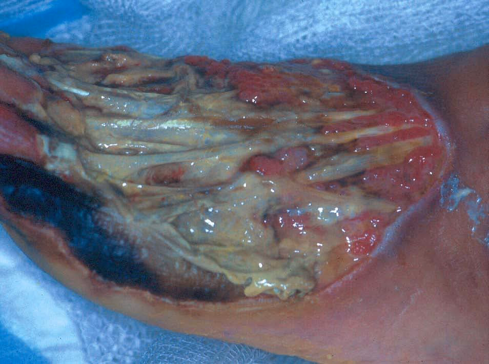 ¿Por qué es importante el manejo de las úlceras?